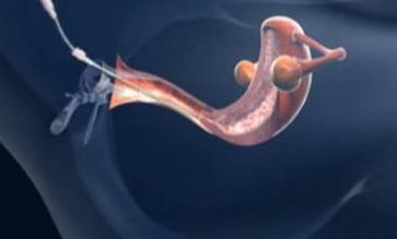 格鲁吉亚和去新加坡做试管助孕的区别大不大？